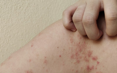 IMPETIGO NA ESCOLA, O QUE É IMPORTANTE SABER?