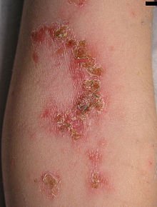 IMPETIGO NÃO BOLHOSO