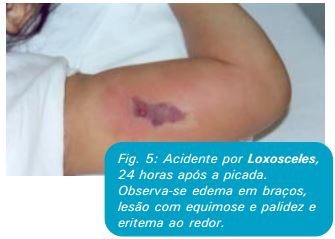 ACIDENTE ARANHA LOXOSCELES