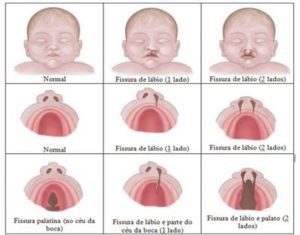 A CRIANÇA COM FISSURA LABIAL E FENDA PALATINA NA ESCOLA - Creche Segura