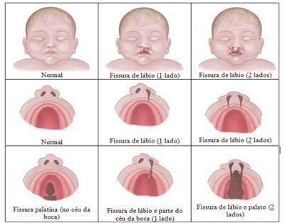 tipos-de-fissura-labial-e-fenda-palatina-desenho